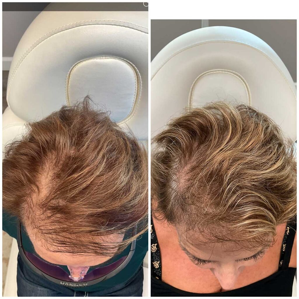 Regenicel Aestheics Before & After
