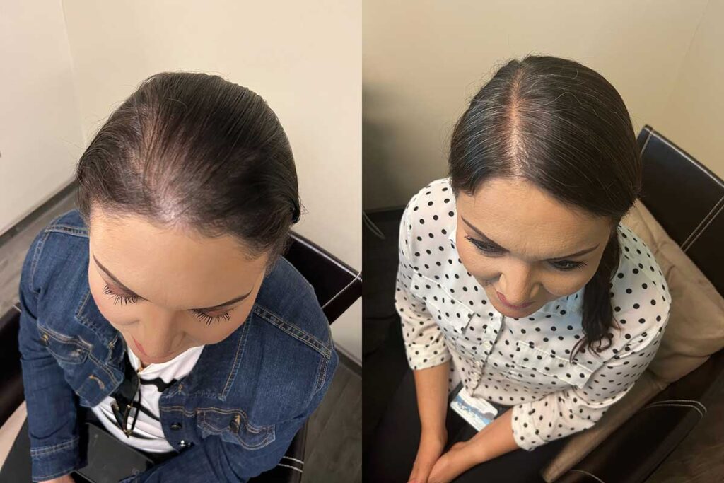 Regenicel Aestheics Before & After