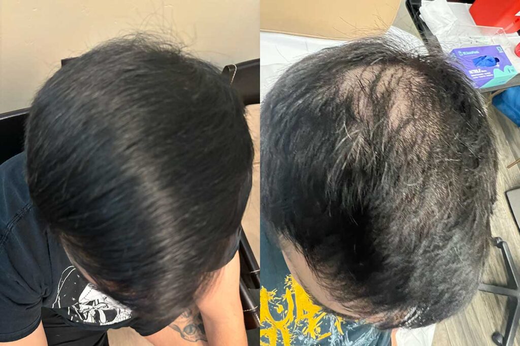 Regenicel Aesthetics Before & After