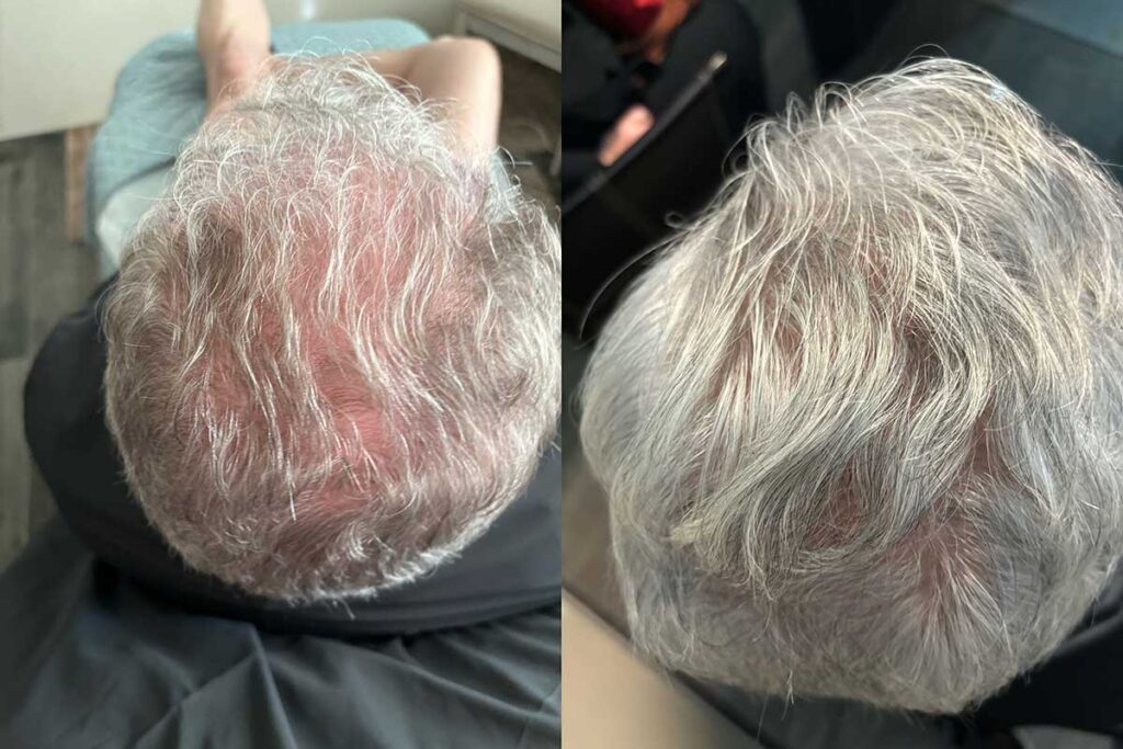 Regenicel Aesthetics Before & After