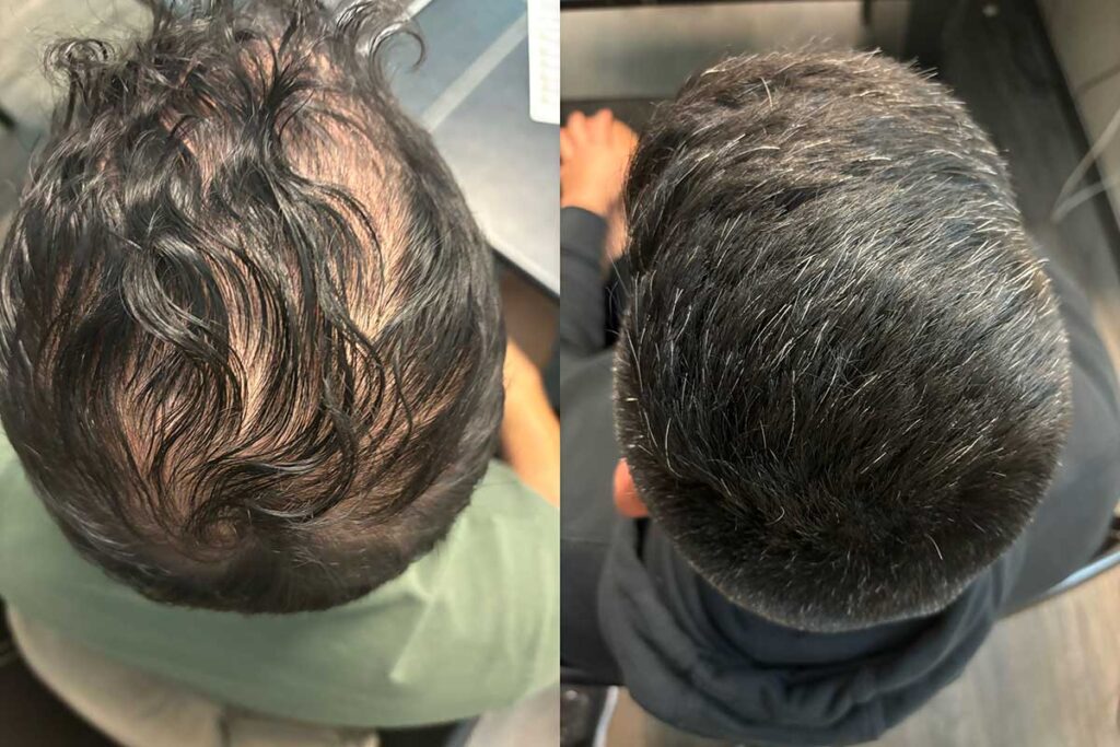Regenicel Aesthetics Before & After