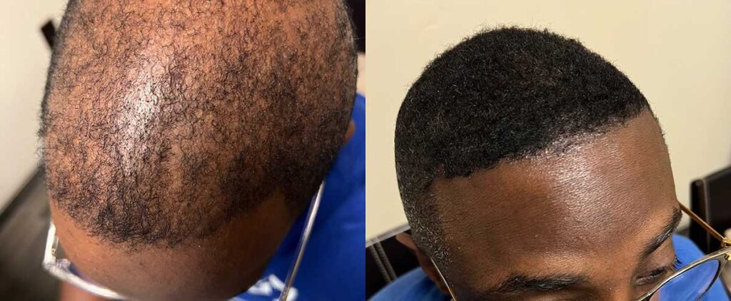 Regenicel Aesthetics Before & After